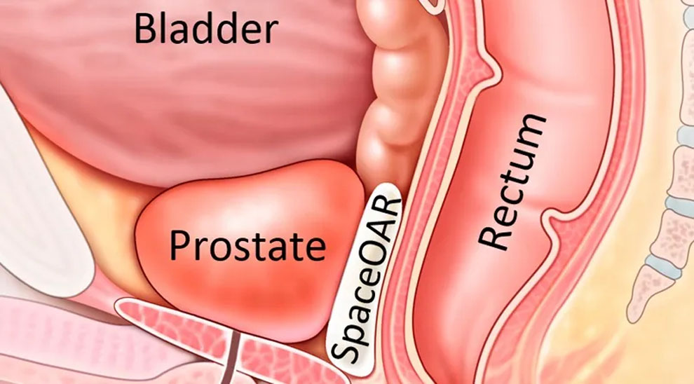 Men Encouraged to Ejaculate More to Reduce Prostate Cancer Risk