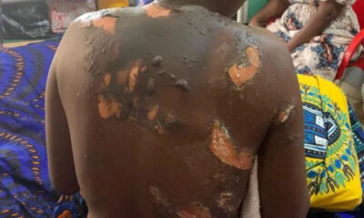 Police to prosecute Kogi man for allegedly setting wife ablaze