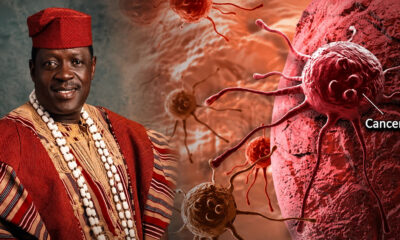 Stage 4 Cancer: Understanding Ogogo's Diagnosis and Treatment Options